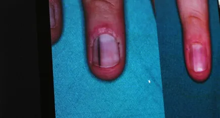 Uzmanlar uyarıyor: Tırnak dibindeki siyah lekeler cilt kanseri belirtisi olabilir!