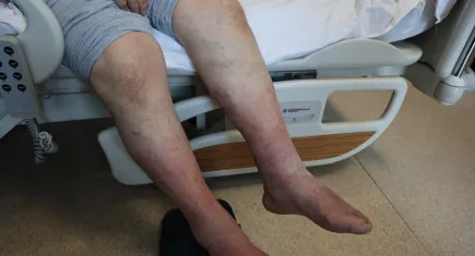 Uzmanı uyardı: Sıcak kum ve şortlar varisi tetikliyor