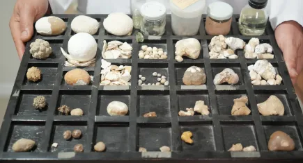 Üroloji Uzmanı, 22 yılda topladığı mesane ve böbrek taşlarıyla farkındalık yaratıyor