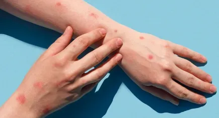 DSÖ'den ikinci küresel acil durum ilanı: Maymun çiçeği virüsü yayılmaya devam ediyor