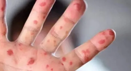 M çiçeği hastalığına dair her şey… Uzmanlar açıkladı!