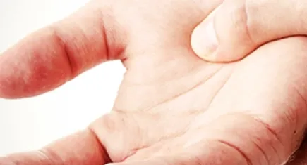 Sapho Sendromu nedir? Belirtileri nelerdir?