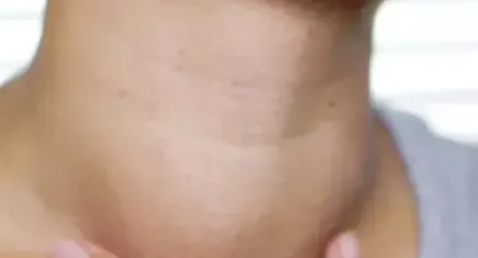 Zehirli guatr belirtileri nelerdir?