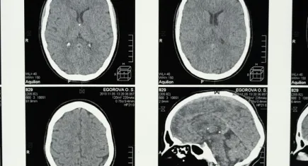 REM uykusundaki aksaklık, Alzheimer'ın erken işareti olabilir