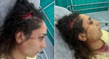 Bakkala giderken sokak köpeklerinin saldırısına uğradı: Genç kadının başında 20 santimetrelik açık oluştu!