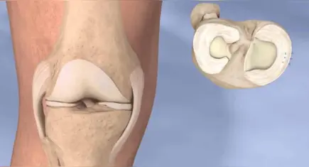 Geçmeyen diz ağrınızın nedeni menisküs yırtığı olabilir!
